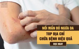 Top 6 cơ sở y tế điều trị nổi mề đay uy tín, hiệu quả tại Hà Nội và Hồ Chí Minh