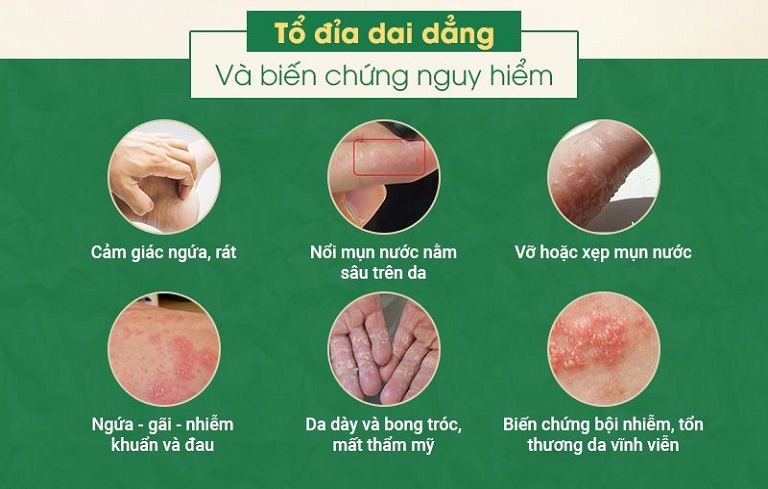 Bệnh tổ đỉa