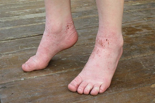 Bệnh tổ đỉa tay chân