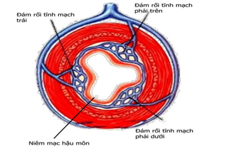 Bệnh trĩ vòng ngày càng phổ biến trong các loại bệnh trĩ hiện nay