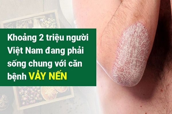 Bệnh nến có chữa được không
