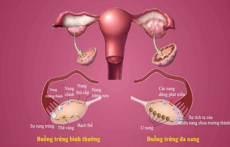 Buồng trứng đa nang là bệnh lý thường gặp ở chị em, hình thành do sự chênh lệch quá lớn giữa hormone nam và nữ