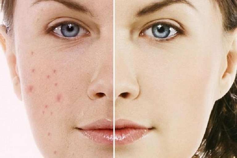cách điều trị mụn thâm
