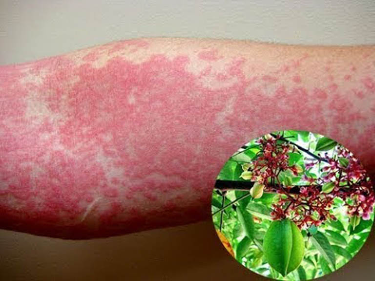 Các cách trị nổi mề đay tại nhà áp dụng sao cho hiệu quả? Bác sĩ Đỗ Minh Tuấn giải thích