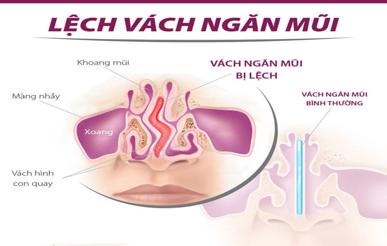 Cấu trúc mũi có vấn đề là nguyên nhân gây viêm xoang