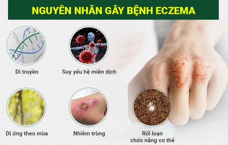 Nguyên nhân gây bệnh chàm 