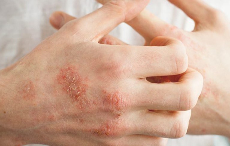 Bệnh chàm eczema