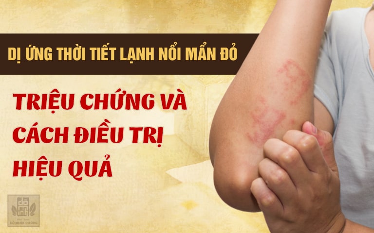 Dị ứng thời tiết lạnh nổi mẩn đỏ: Triệu chứng và cách chữa hiệu quả từ thảo dược
