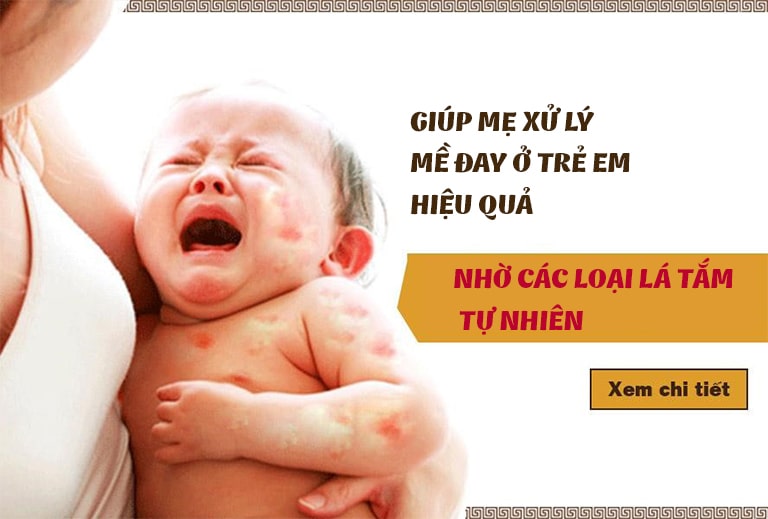 Trẻ bị nổi mề đay tắm lá gì cho an toàn? - Chuyên gia, BS.Đỗ Minh Tuấn giải đáp