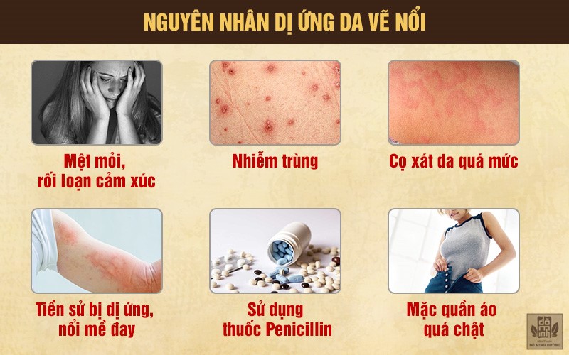 Nguyên nhân gây dị ứng da vẽ nổi mọi người cần biết