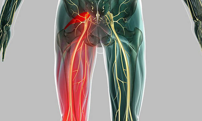 Dây thần kinh tọa được xác định từ vùng thắt lưng dưới kéo dài xuống bàn chân