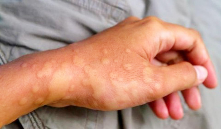 Dị ứng thời tiết lạnh nổi mẩn đỏ dễ nhận biết thông qua triệu chứng ngoài da