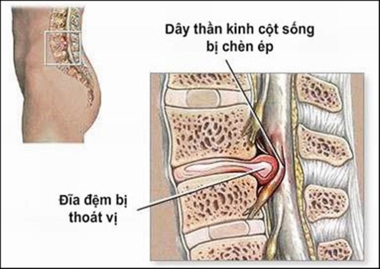 Thoát vị đĩa đệm là bệnh lý phổ biến gây đau lưng đến mức không khom người được