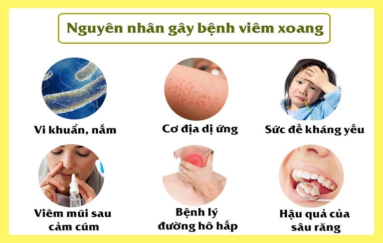 Có nhiều nguyên nhân gây ra tình trạng bệnh viêm xoang cấp