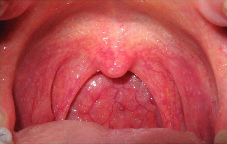 Niêm mạc họng sưng đỏ tùy thuộc vào mức độ viêm nhiễm