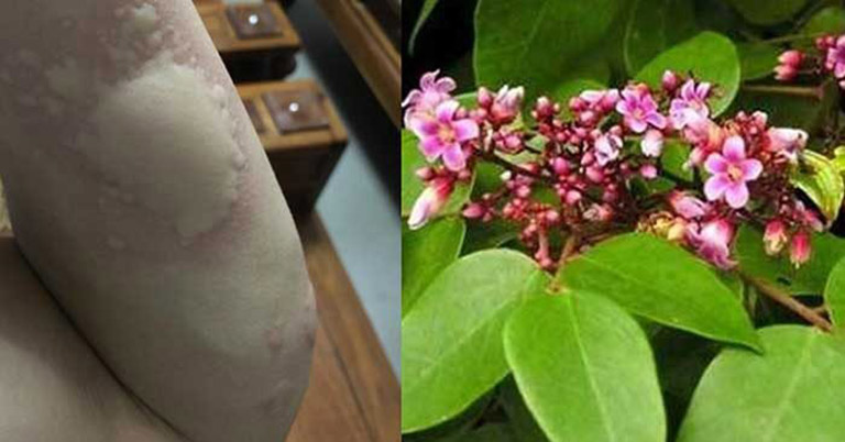 Các cách trị nổi mề đay tại nhà áp dụng sao cho hiệu quả? Bác sĩ Đỗ Minh Tuấn giải thích