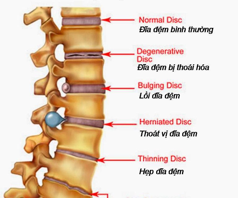 Phồng lồi đĩa đệm