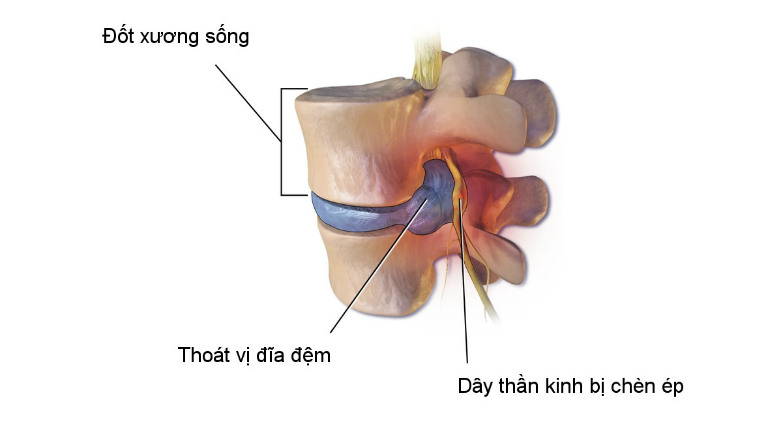 Thoát vị đĩa đệm là tình trạng đĩa đệm bị lệch khỏi vị trí, chèn ép dây thần kinh.