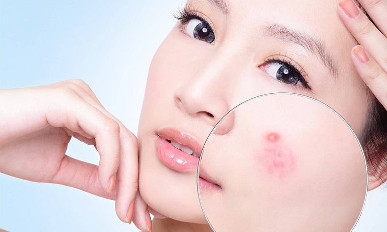 Thuốc trị mụn ẩn