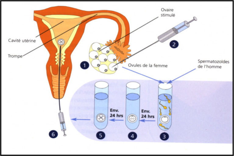 Quy trình thực hiện kỹ thuật IVF khá phức tạp và đòi hỏi điều kiện vô trùng nghiêm ngặt