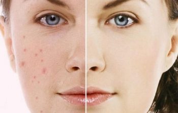 Cách trị mụn trứng cá
