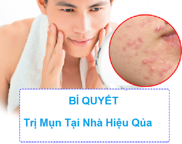 cách trị mụn tại nhà