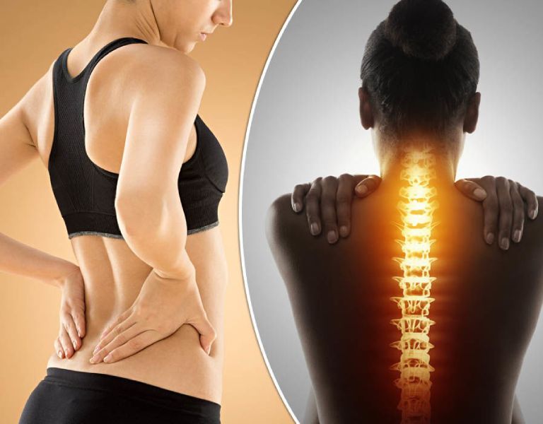 Triệu chứng phồng lồi đĩa đệm