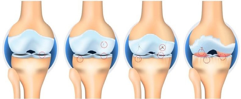 Ở mức độ nhẹ, người bị thoái hóa khớp gối có thể chữa khỏi hoàn toàn bệnh bằng công nghệ tế bào gốc