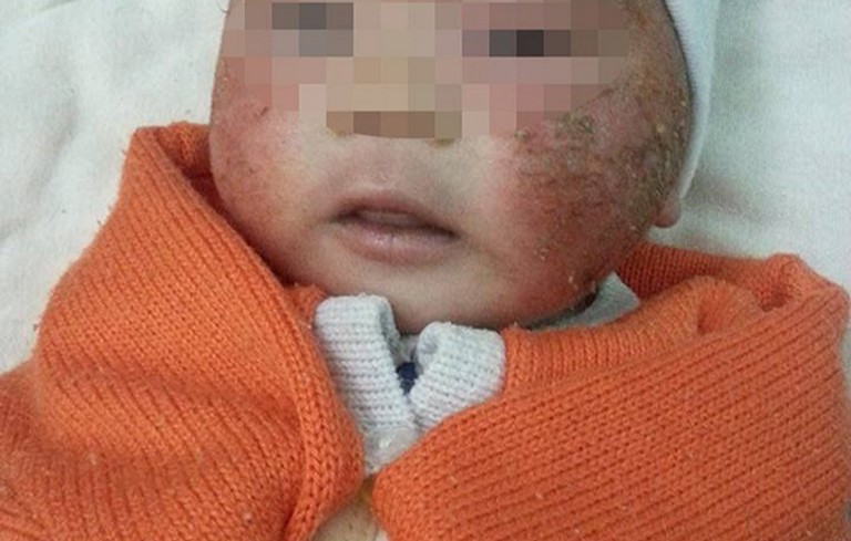 Viêm da cơ địa bội nhiễm