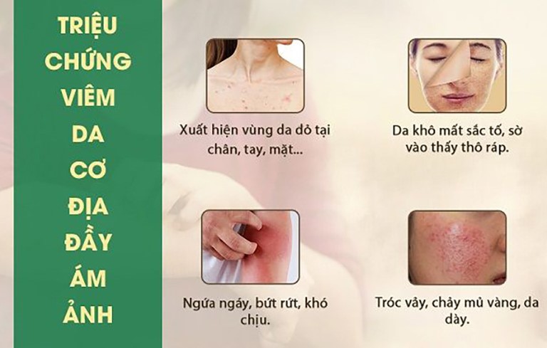 Các triệu chứng bệnh