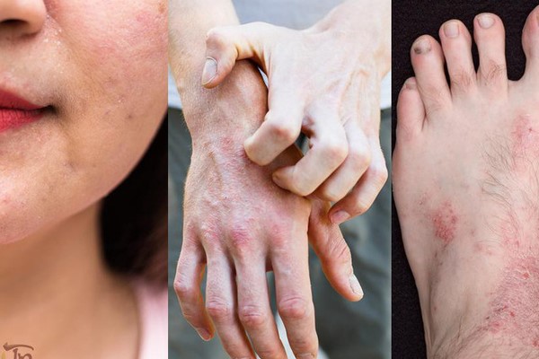 Hình ảnh viêm da cơ địa dị ứng