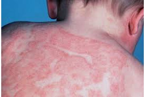Viêm da cơ địa ở trẻ em