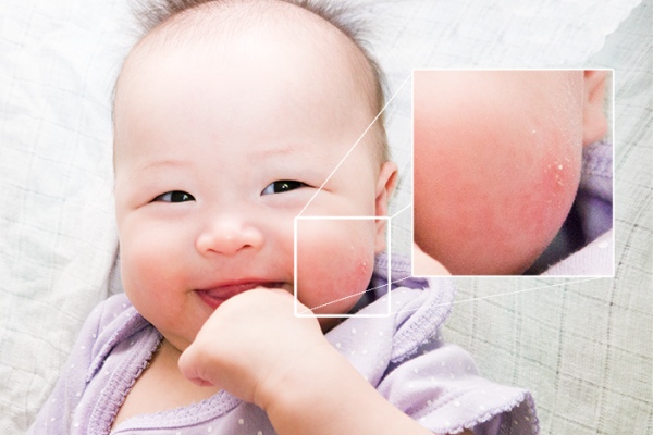 Viêm da dị ứng ở trẻ em