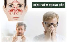 Viêm xoang cấp