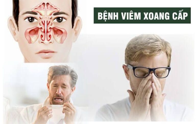 Viêm xoang cấp