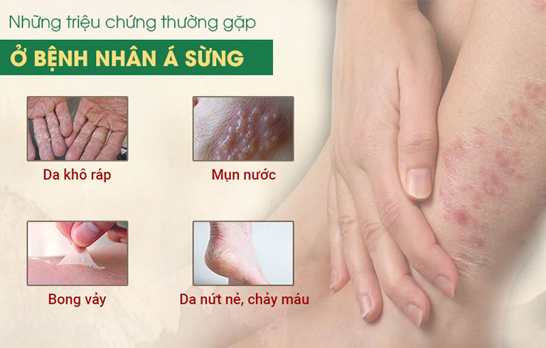 Các triệu chứng thường gặp của bệnh