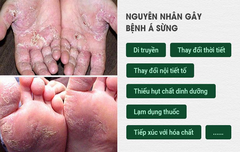 Nguyên nhân gây bệnh á sừng 