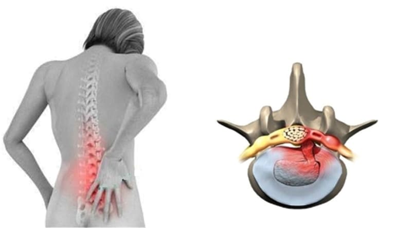 Thoát vị đĩa đệm là một trong những bệnh về xương khớp thường gặp gây đau nhức lưng gần mông.