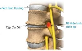 Xẹp đĩa đệm cột sống lưng là một trong những bệnh lý về xương khớp rất thường gặp. Đối tượng mắc bệnh này đang có xu hướng trẻ hóa.