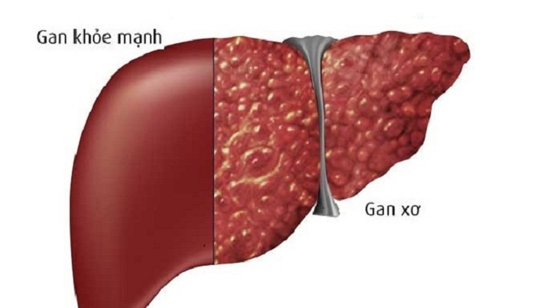 Xơ gan cổ trướng là bệnh nguy hiểm, đe dọa tới tính mạng