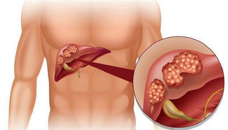 Người bị xơ gan mất bù có thể kéo dài tuổi thọ từ 1 - 3 năm 