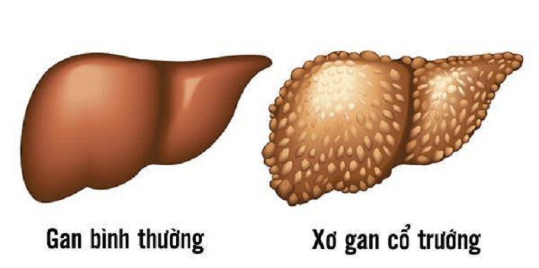Bệnh xơ gan cổ trướng lây không