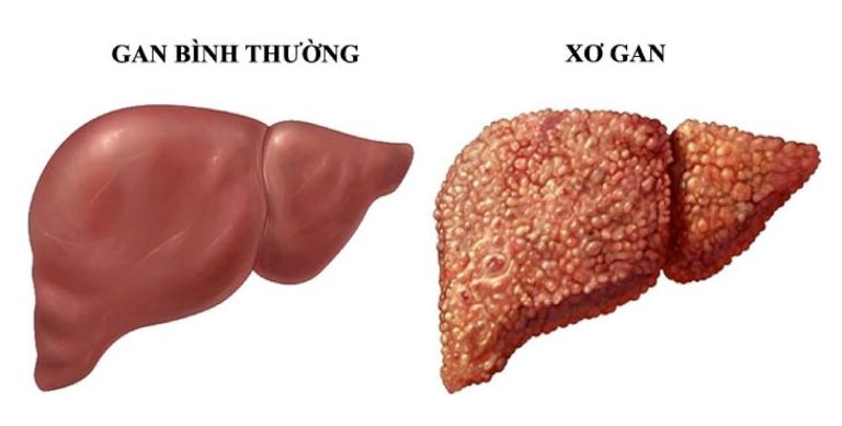 Gan bình thường và khi bị xơ