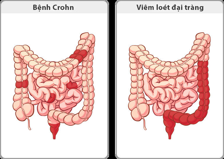 So sánh bệnh Crohn và bệnh viêm loét đại tràng