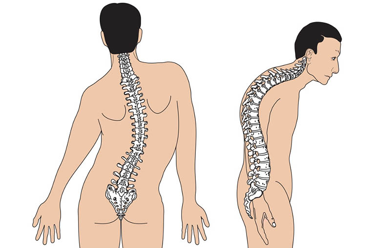 Nguyên nhân cơ học khiến người bệnh bị đau cột sống lưng dưới