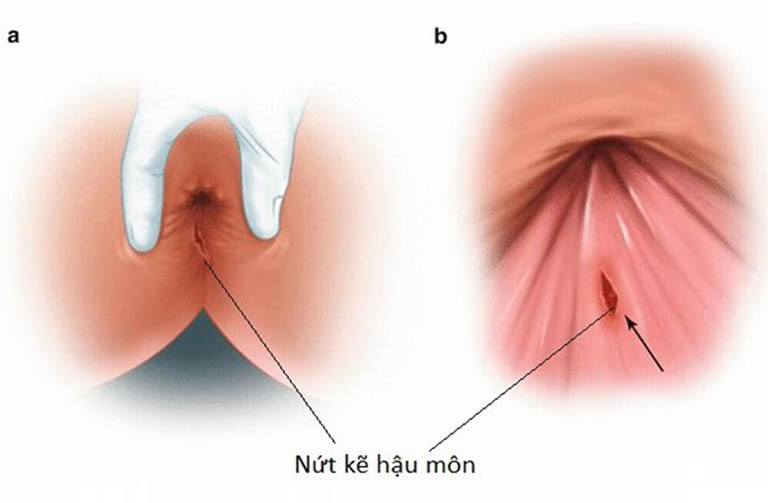 Bị nứt kẽ hậu môn bao lâu thì khỏi?