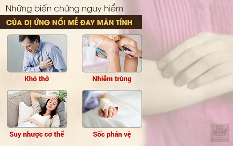 Biến chứng của bệnh mề đay mãn tính không phải ai cũng biết