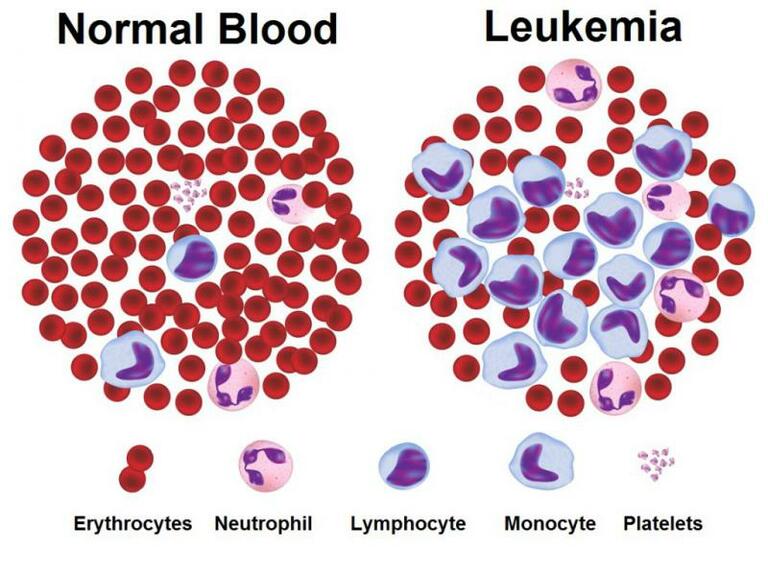 Xét nghiệm tế bào ngoại vi trong máu sẽ phân biệt được bệnh viêm khớp dạng thấp với bệnh bạch cầu.