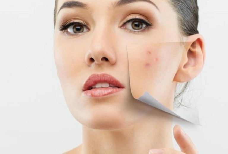 Cách trị mụn trứng cá hiệu quả