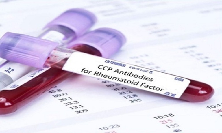 Xét nghiệm cùng lúc cả chỉ số RF và Anti CCP sẽ cho kết quả chẩn đoán bệnh viêm khớp dạng thấp chính xác hơn.